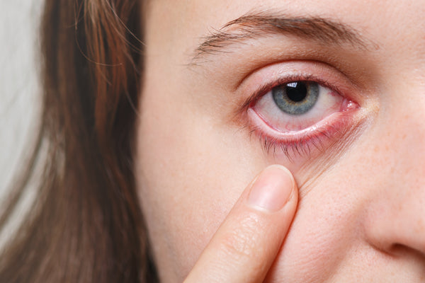 DRY EYES ?