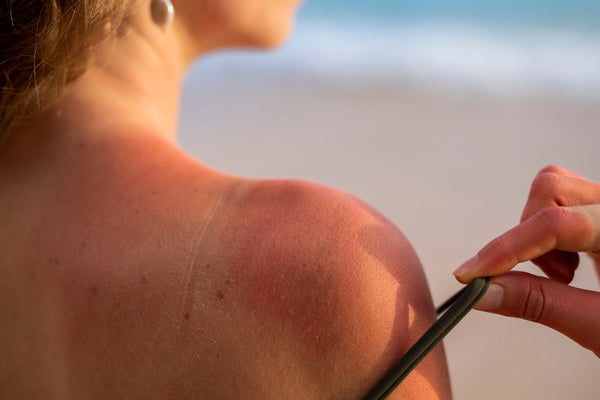 SKIN TANNING& SUN DAMAGE ?